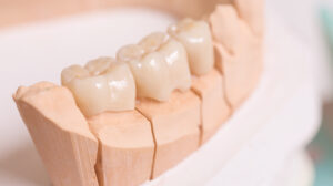 The Cost and Benefits of Fixed Bridge Dental Service in Manila Philippines