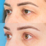 Things to Consider Before Opting for a Double Eyelid Surgery