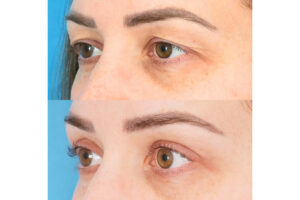 Things to Consider Before Opting for a Double Eyelid Surgery