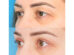 Things to Consider Before Opting for a Double Eyelid Surgery